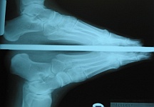 toes surgery nail fungus therapy x-ray ulcer ingrown toenail
